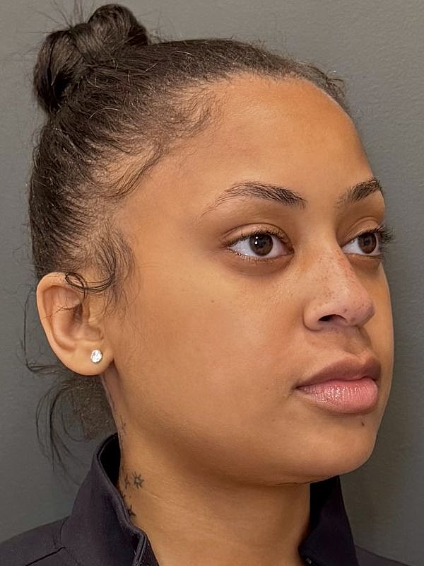 Lip Filler  Before & After