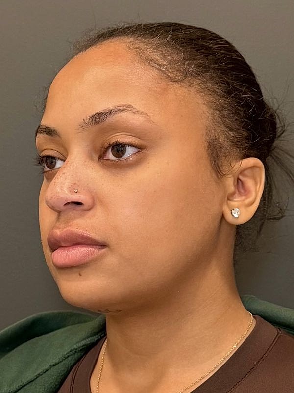 Lip Filler  Before & After