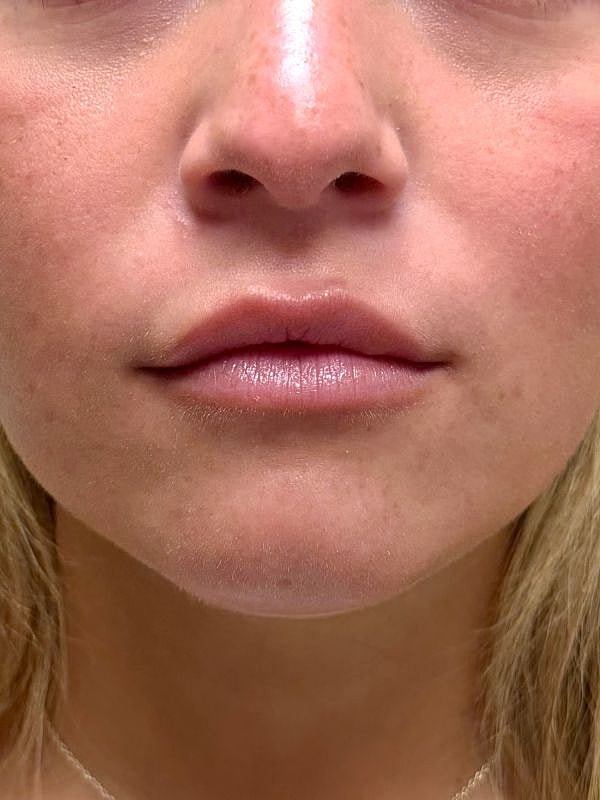 Lip Filler  Before & After