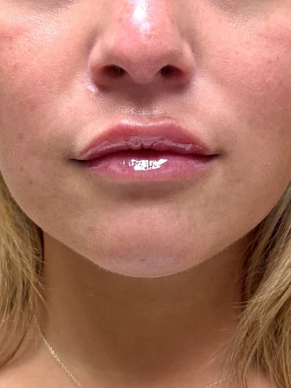 Lip Filler  Before & After