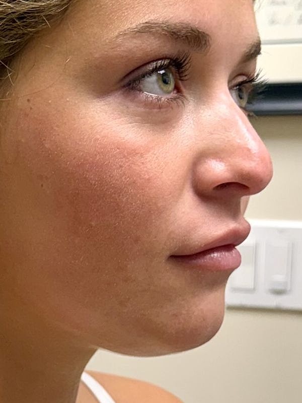 Lip Filler  Before & After