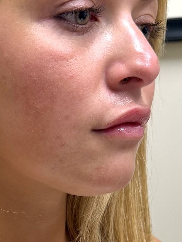 Lip Filler  Before & After