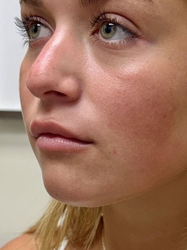 Lip Filler  Before & After