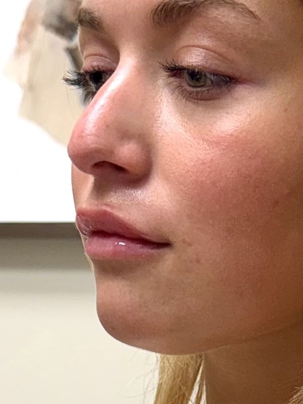 Lip Filler  Before & After