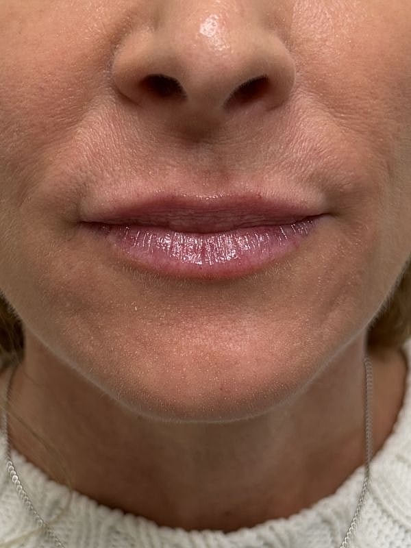 Lip Filler  Before & After