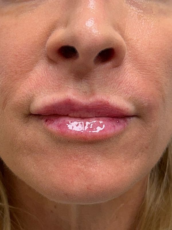 Lip Filler  Before & After