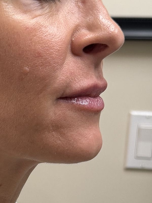 Lip Filler  Before & After