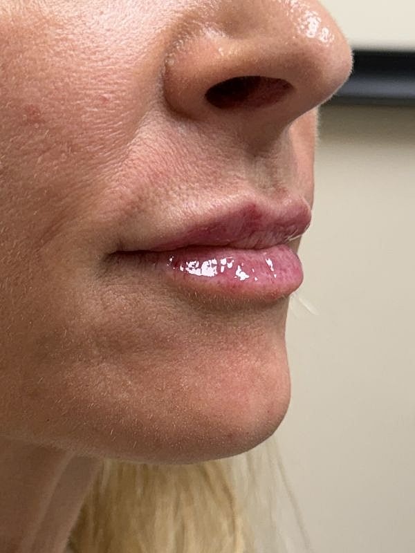 Lip Filler  Before & After
