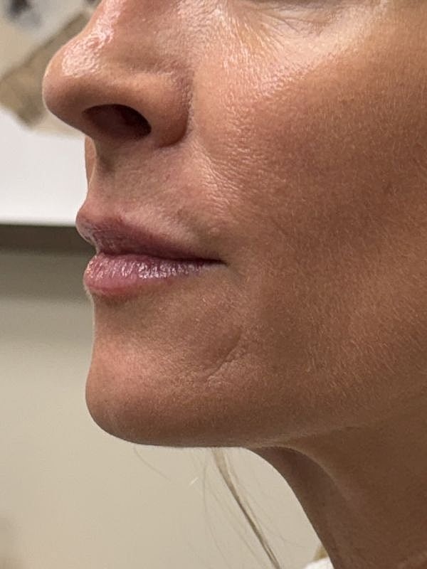 Lip Filler  Before & After