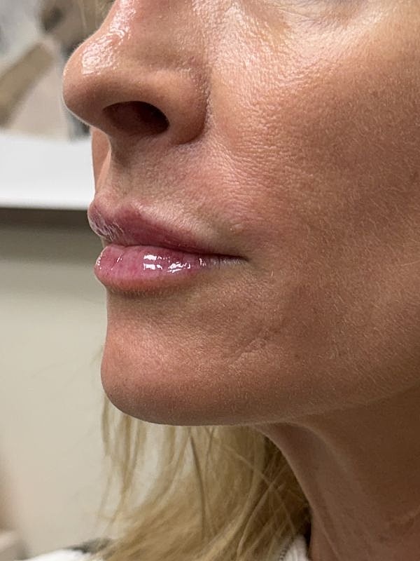 Lip Filler  Before & After