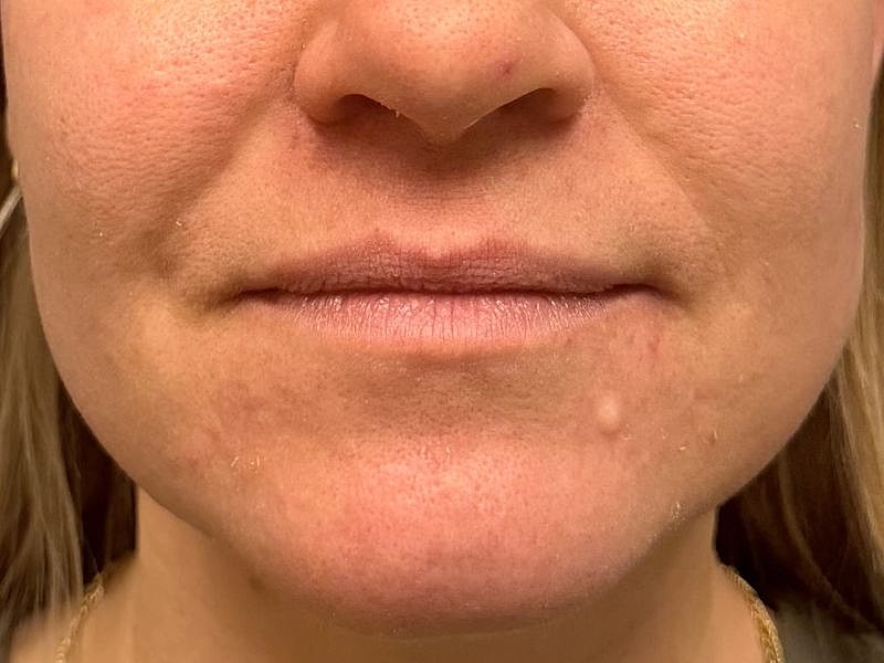 Lip Filler  Before & After