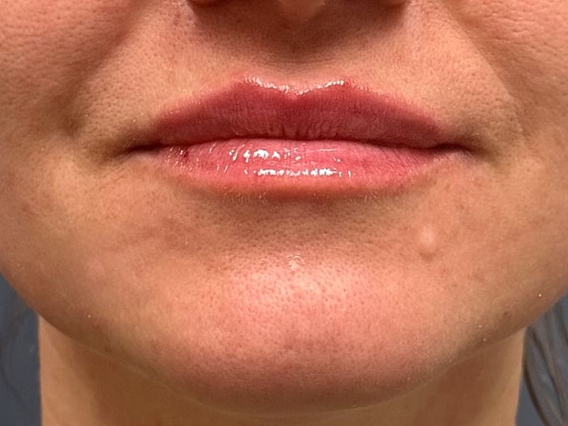 Lip Filler  Before & After