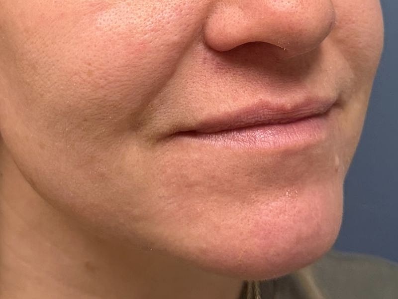 Lip Filler  Before & After