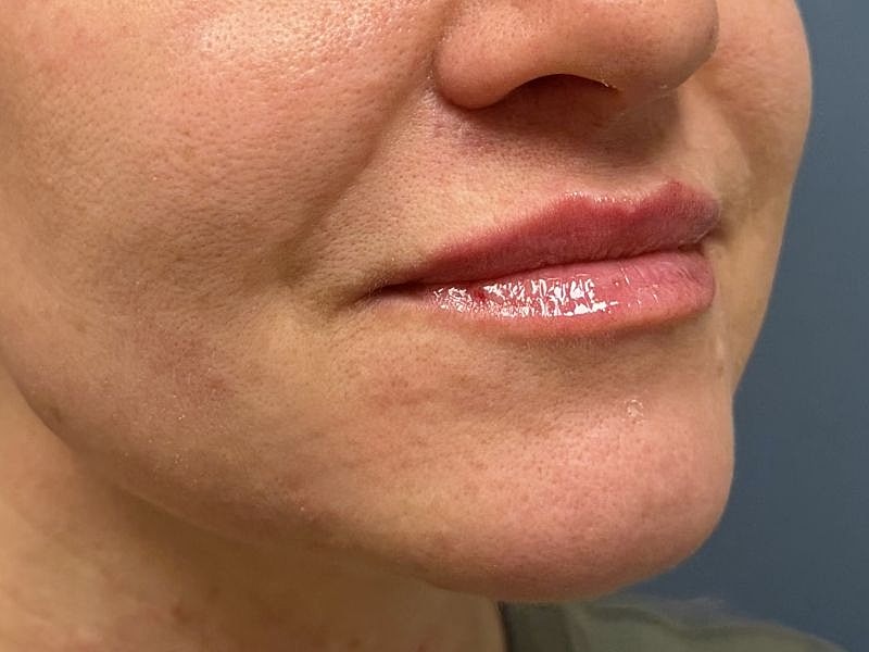 Lip Filler  Before & After
