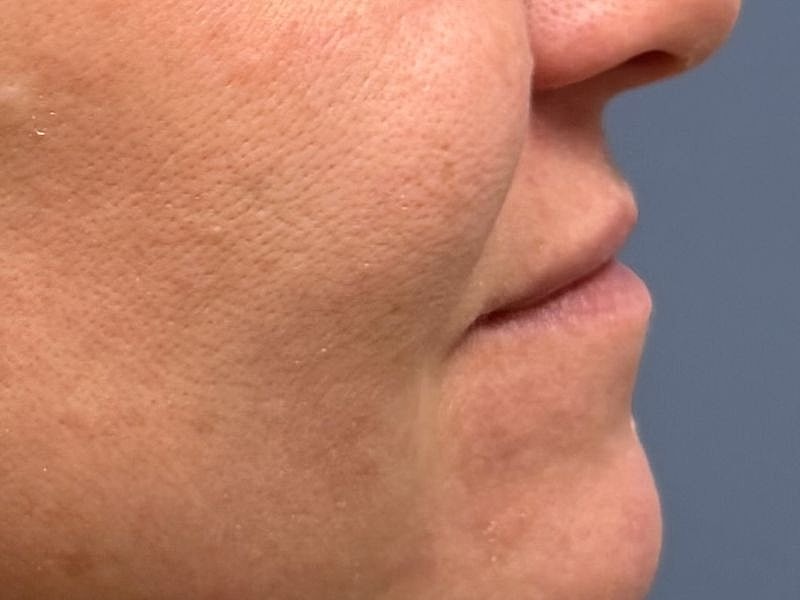 Lip Filler  Before & After
