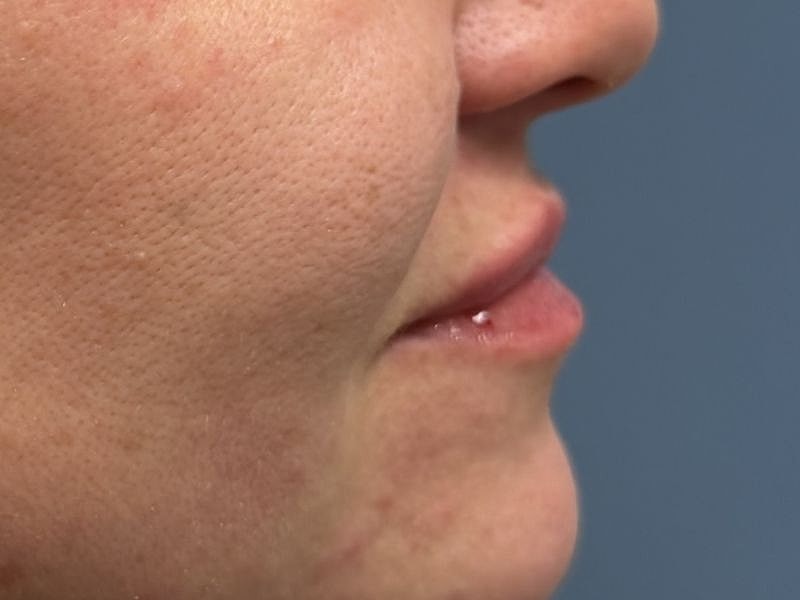 Lip Filler  Before & After