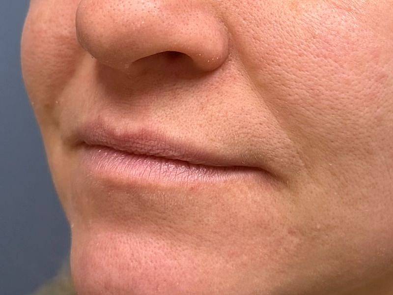 Lip Filler  Before & After