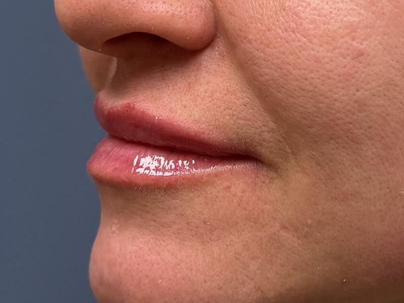 Lip Filler  Before & After