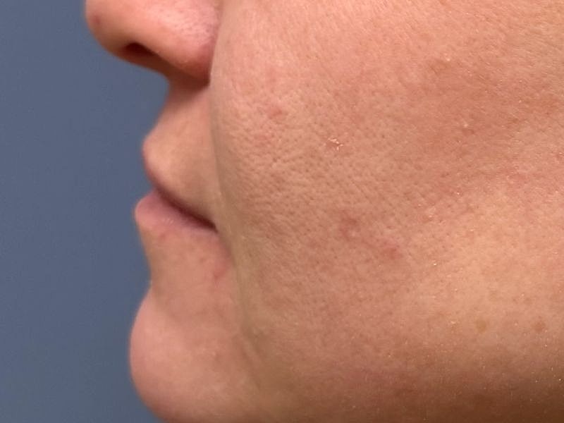 Lip Filler  Before & After