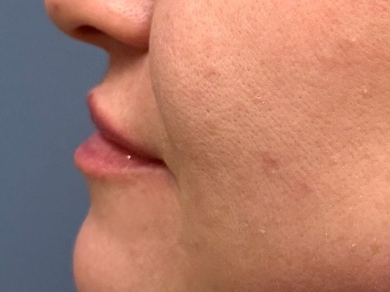 Lip Filler  Before & After