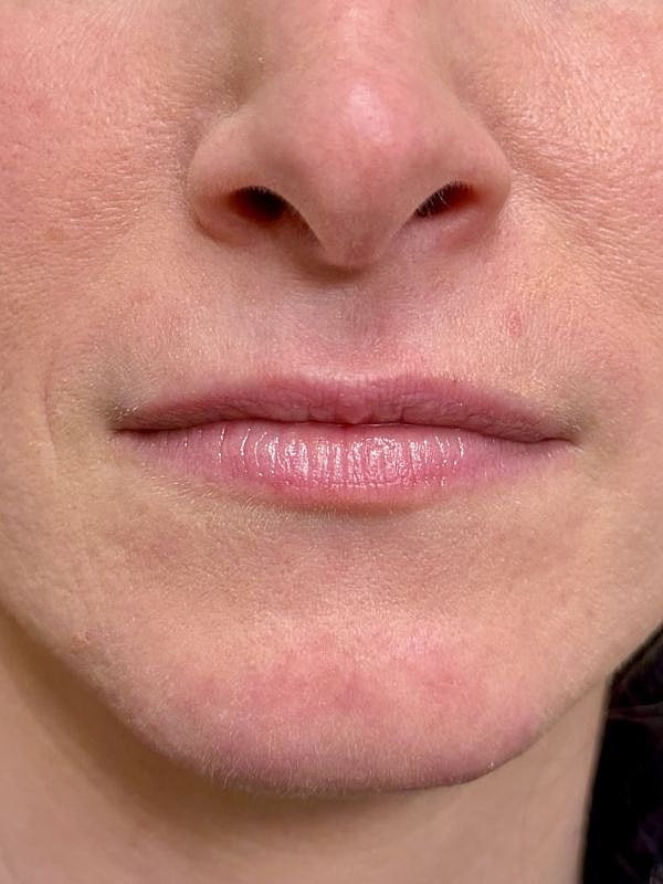 Lip Filler  Before & After