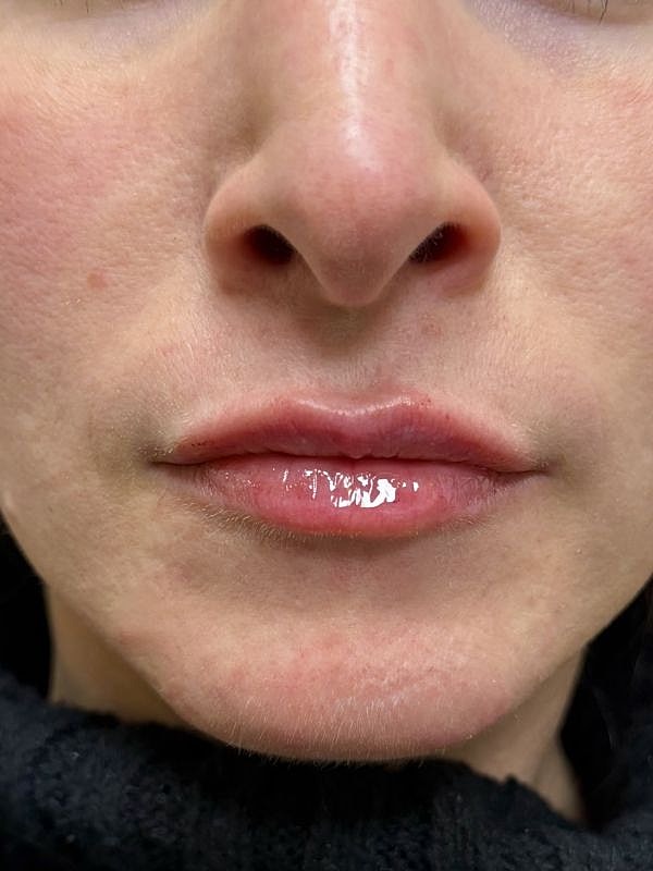 Lip Filler  Before & After