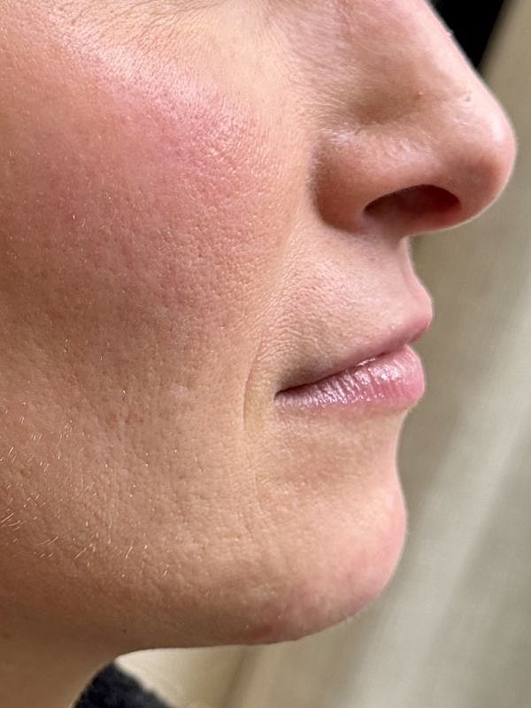 Lip Filler  Before & After