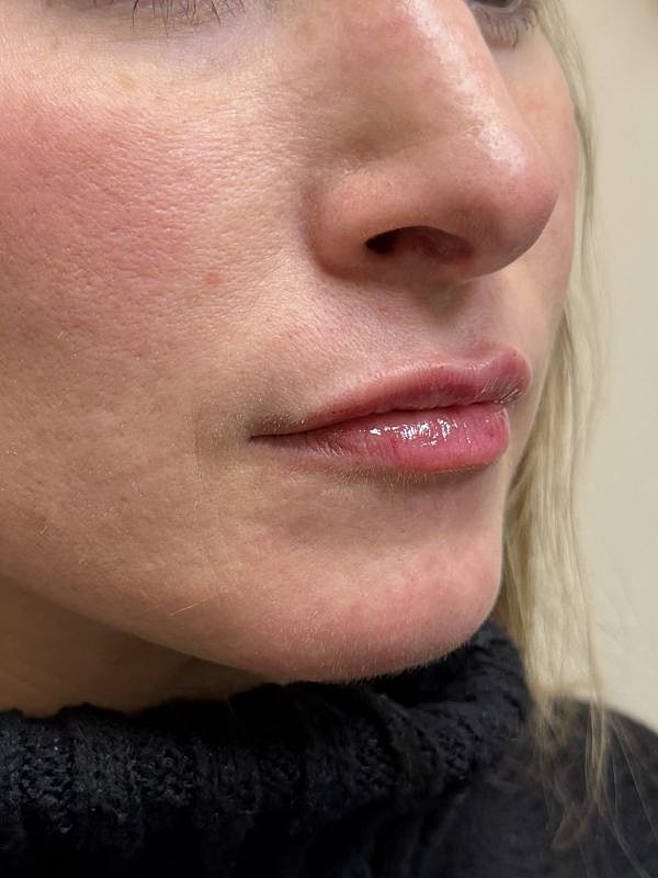Lip Filler  Before & After