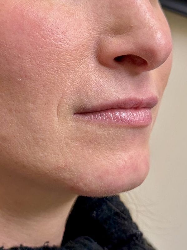 Lip Filler  Before & After