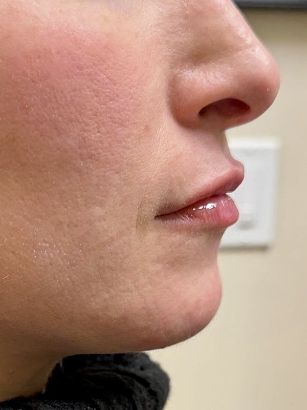 Lip Filler  Before & After
