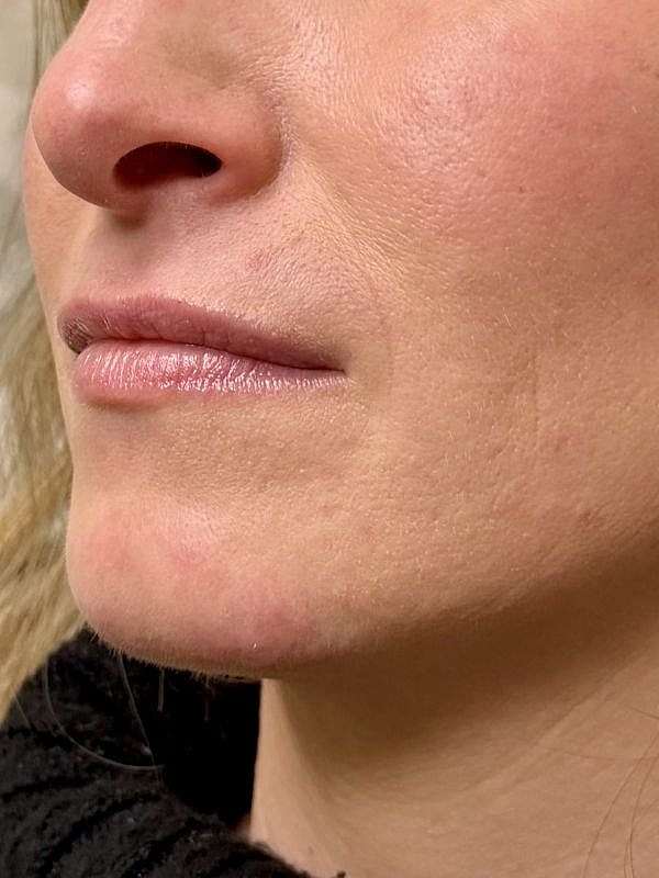 Lip Filler  Before & After