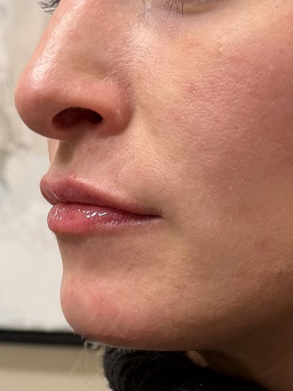 Lip Filler  Before & After