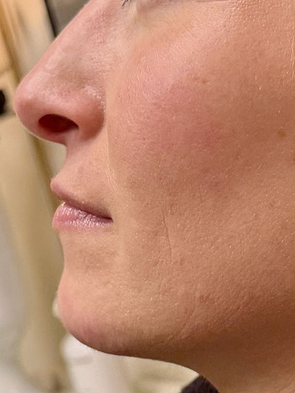 Lip Filler  Before & After