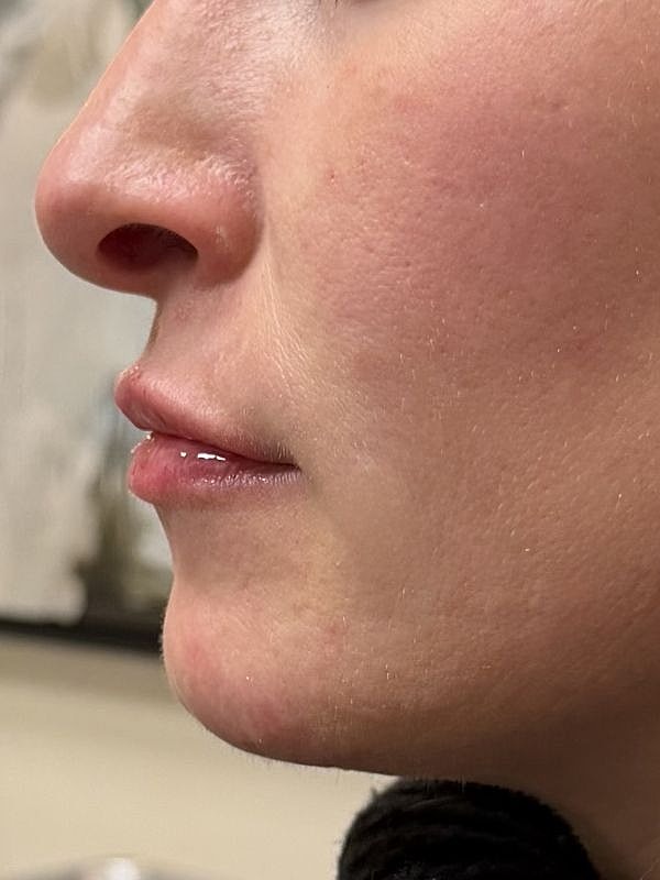 Lip Filler  Before & After