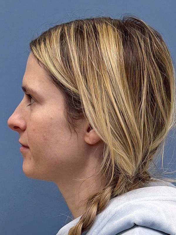 Lip Filler  Before & After