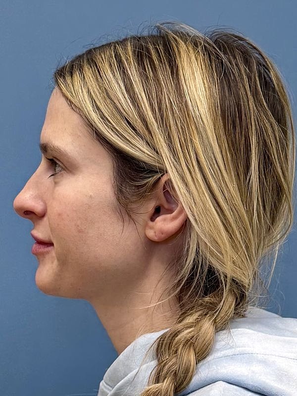 Lip Filler  Before & After