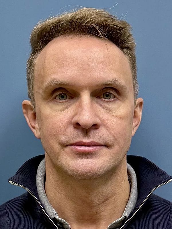 Dermal Filler/Facial Balancing Before & After