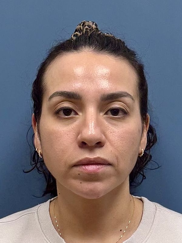 Dermal Filler/Facial Balancing Before & After