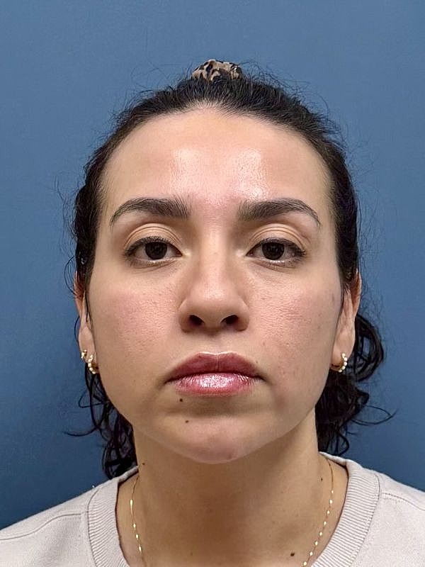 Dermal Filler/Facial Balancing Before & After