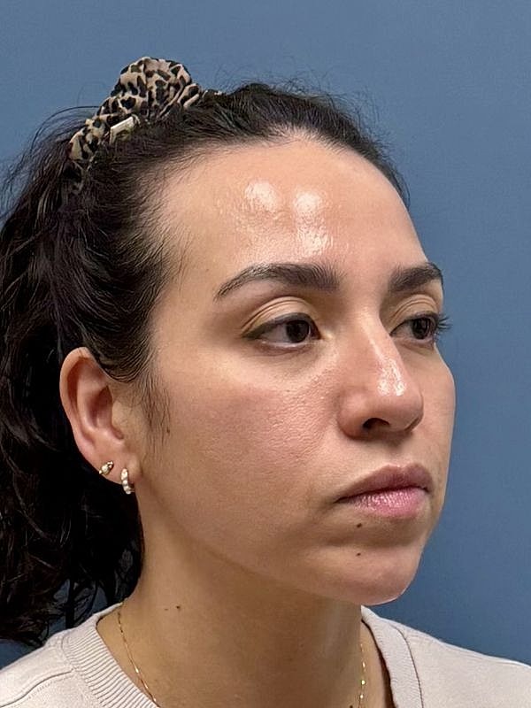 Dermal Filler/Facial Balancing Before & After