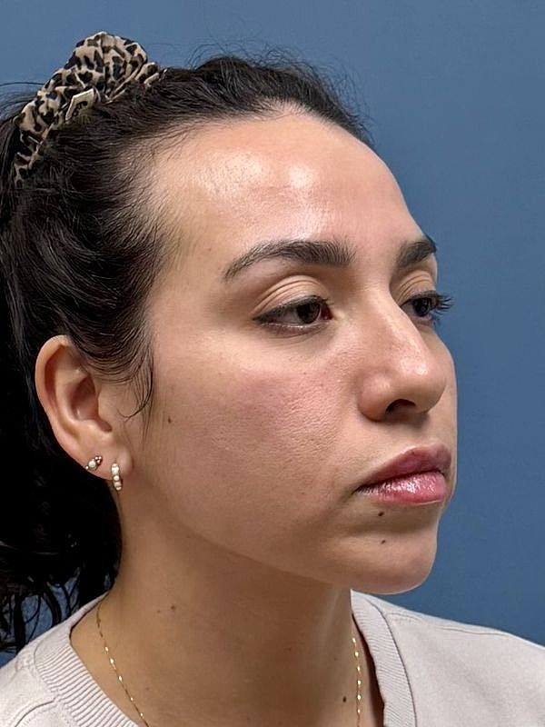 Dermal Filler/Facial Balancing Before & After