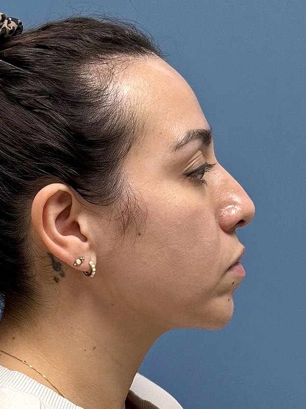 Dermal Filler/Facial Balancing Before & After