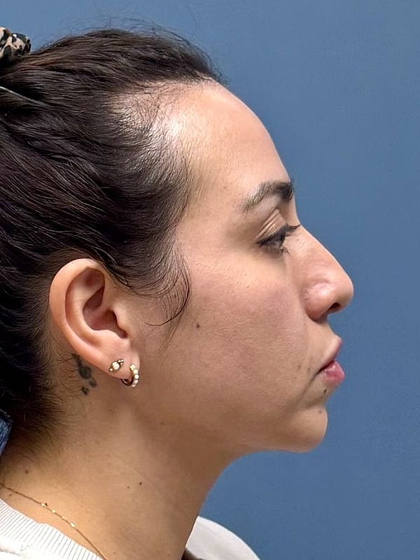 Dermal Filler/Facial Balancing Before & After