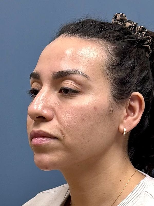 Dermal Filler/Facial Balancing Before & After