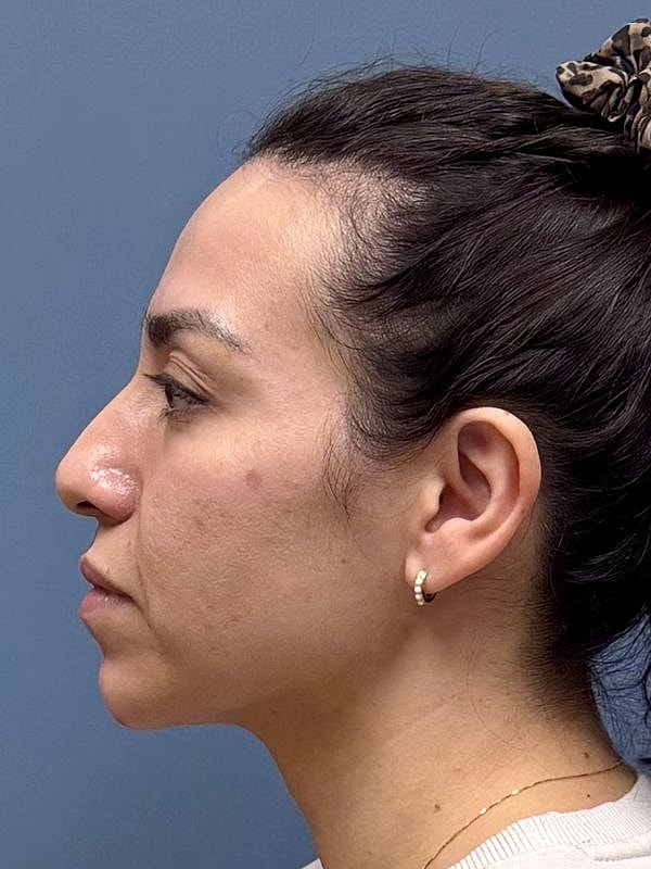 Dermal Filler/Facial Balancing Before & After