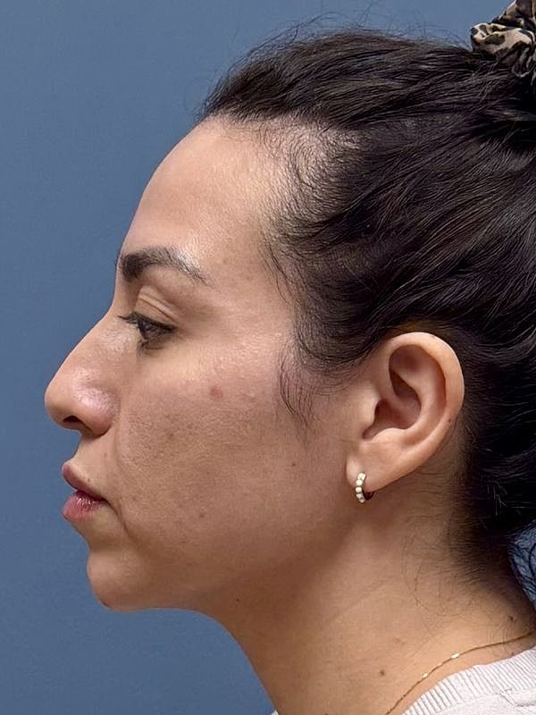 Dermal Filler/Facial Balancing Before & After