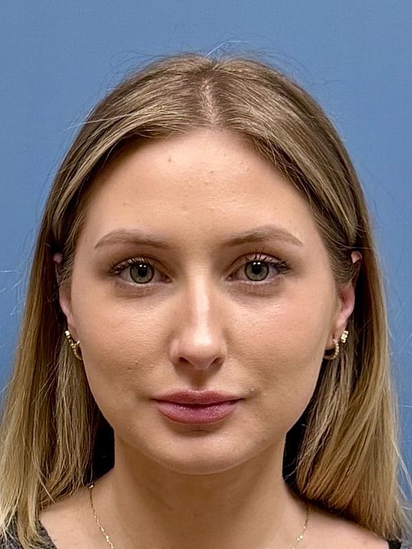 Dermal Filler/Facial Balancing Before & After