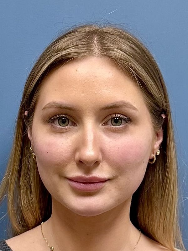 Dermal Filler/Facial Balancing Before & After