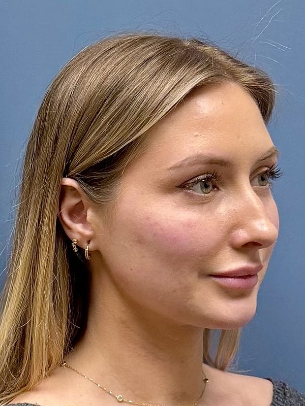 Dermal Filler/Facial Balancing Before & After