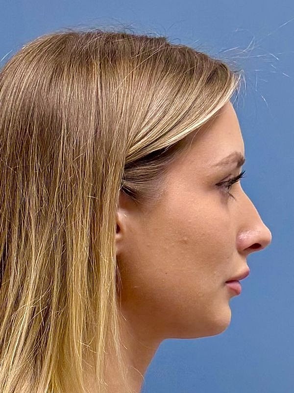 Dermal Filler/Facial Balancing Before & After